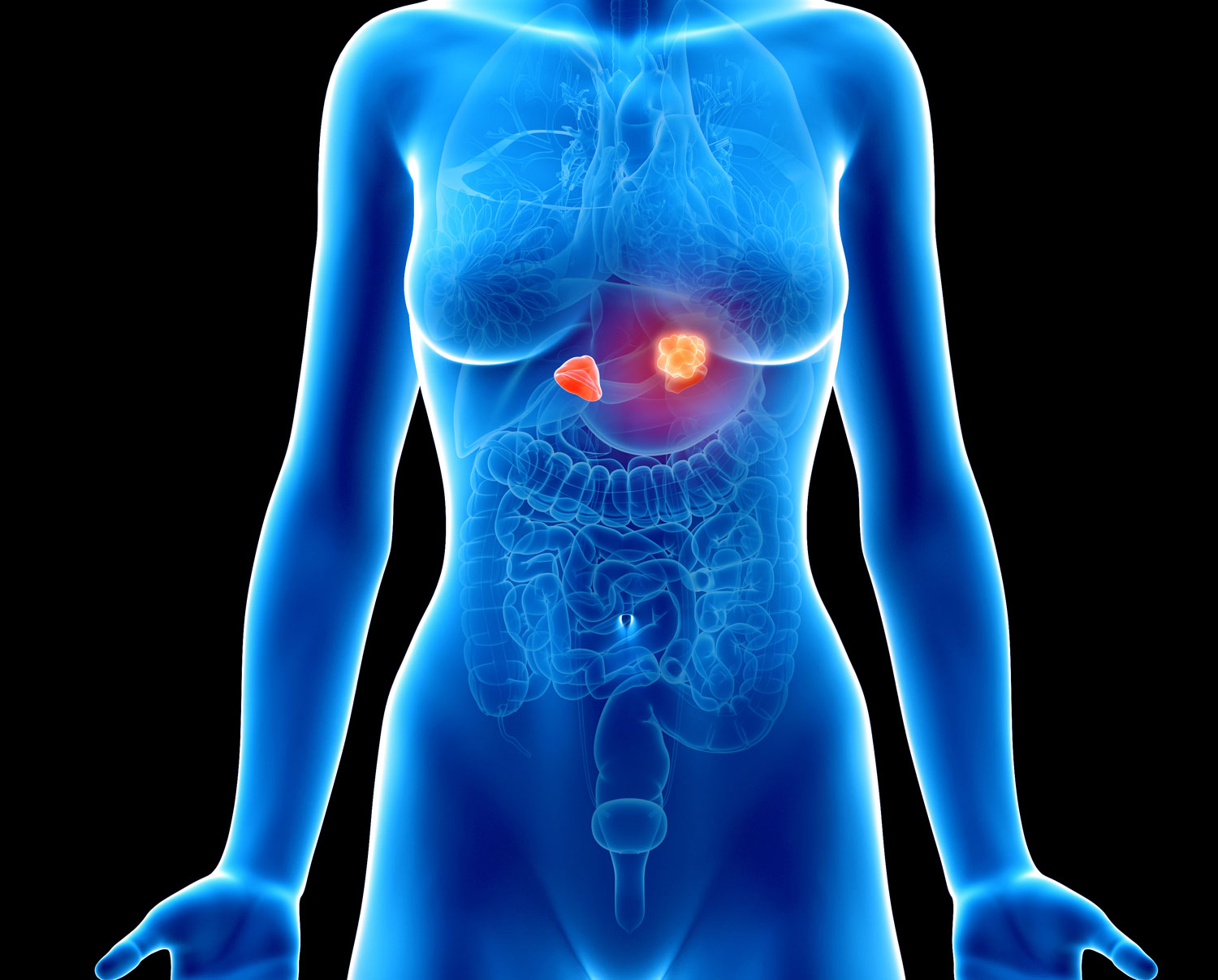 Medical illustration of a female torso showing internal organs, with the adrenal glands highlighted and an adrenal tumour indicated
